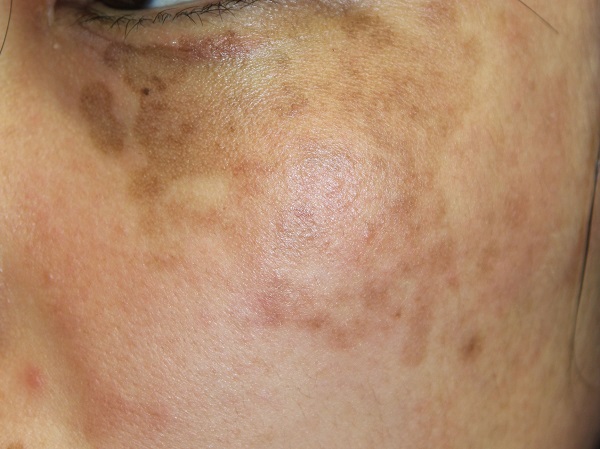 trị nám chân sâu bằng laser